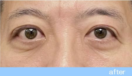 眼瞼下垂の症例３眼瞼挙筋前転法、目の下のクマ取り手術の術後