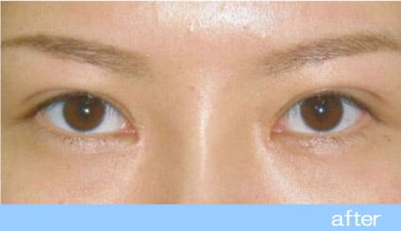 眼瞼下垂の症例１挙筋タッキング法の術後
