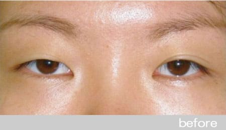 眼瞼下垂の症例１挙筋タッキング法の術前