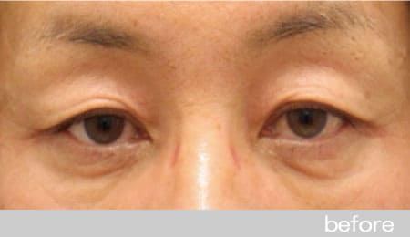 眼瞼下垂の症例５眉毛下皮膚切除法の術前