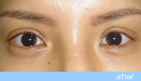 眼瞼下垂の症例２挙筋タッキング法の術後