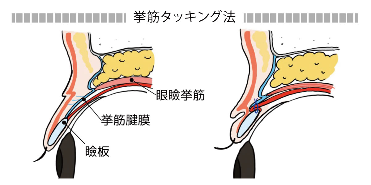 挙筋タッキング法イメージ