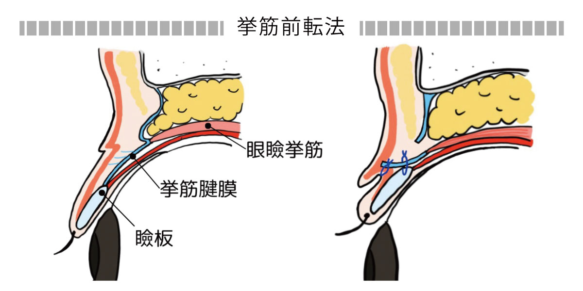 眼瞼挙筋前転法イメージ