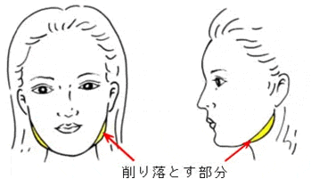 エラ 頬骨の整形 フェイスライン 銀座みゆき通り美容外科大阪院