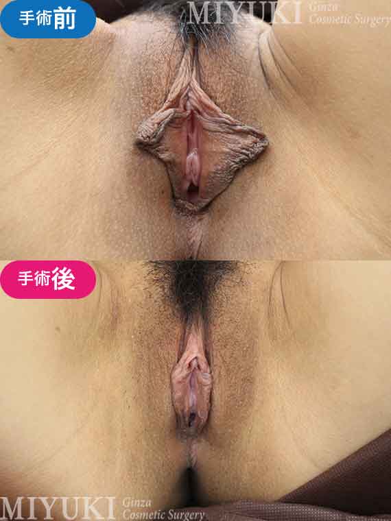 モニター№015小陰唇縮小術の症例画像