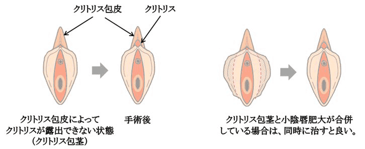 クリトリス包茎手術のイメージ