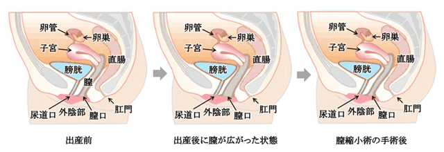 膣縮小手術のイメージ