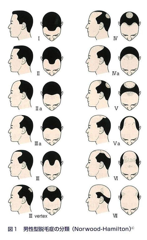 男性型脱毛症の分類