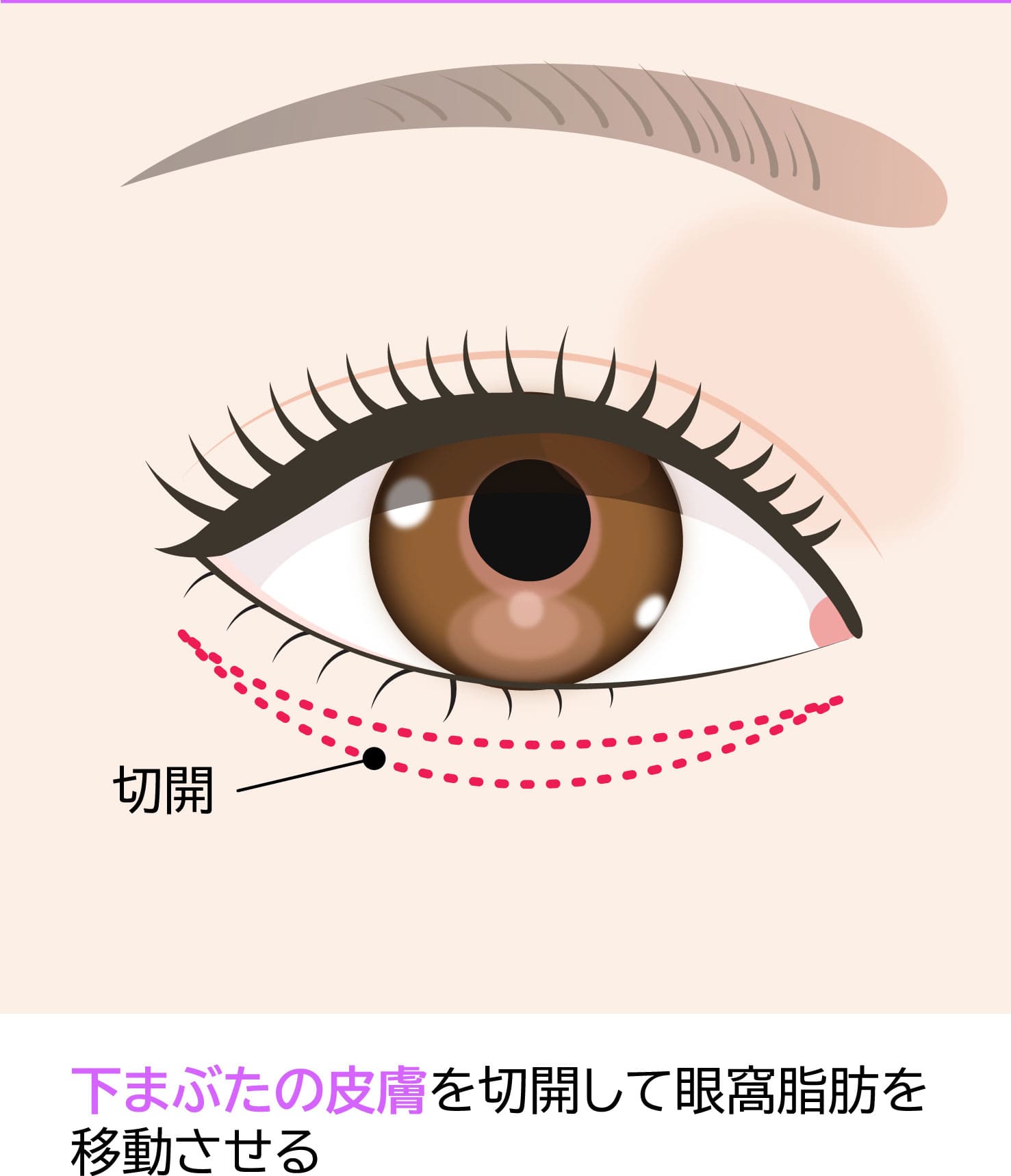 目の下のクマ「表ハムラ法の切開デザインイメージ01」