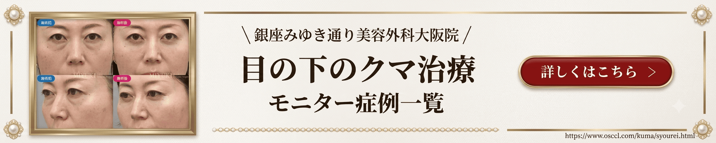 目の下のクマ治療モニター症例一覧へ