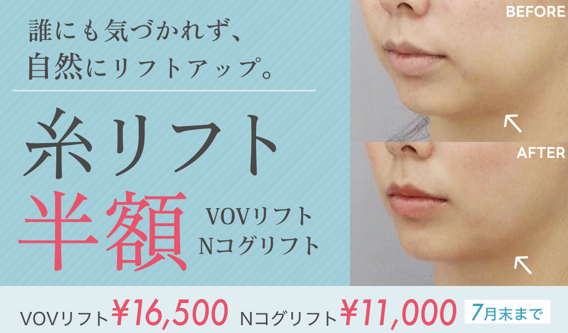 Ncog VOV糸リフト７月末まで