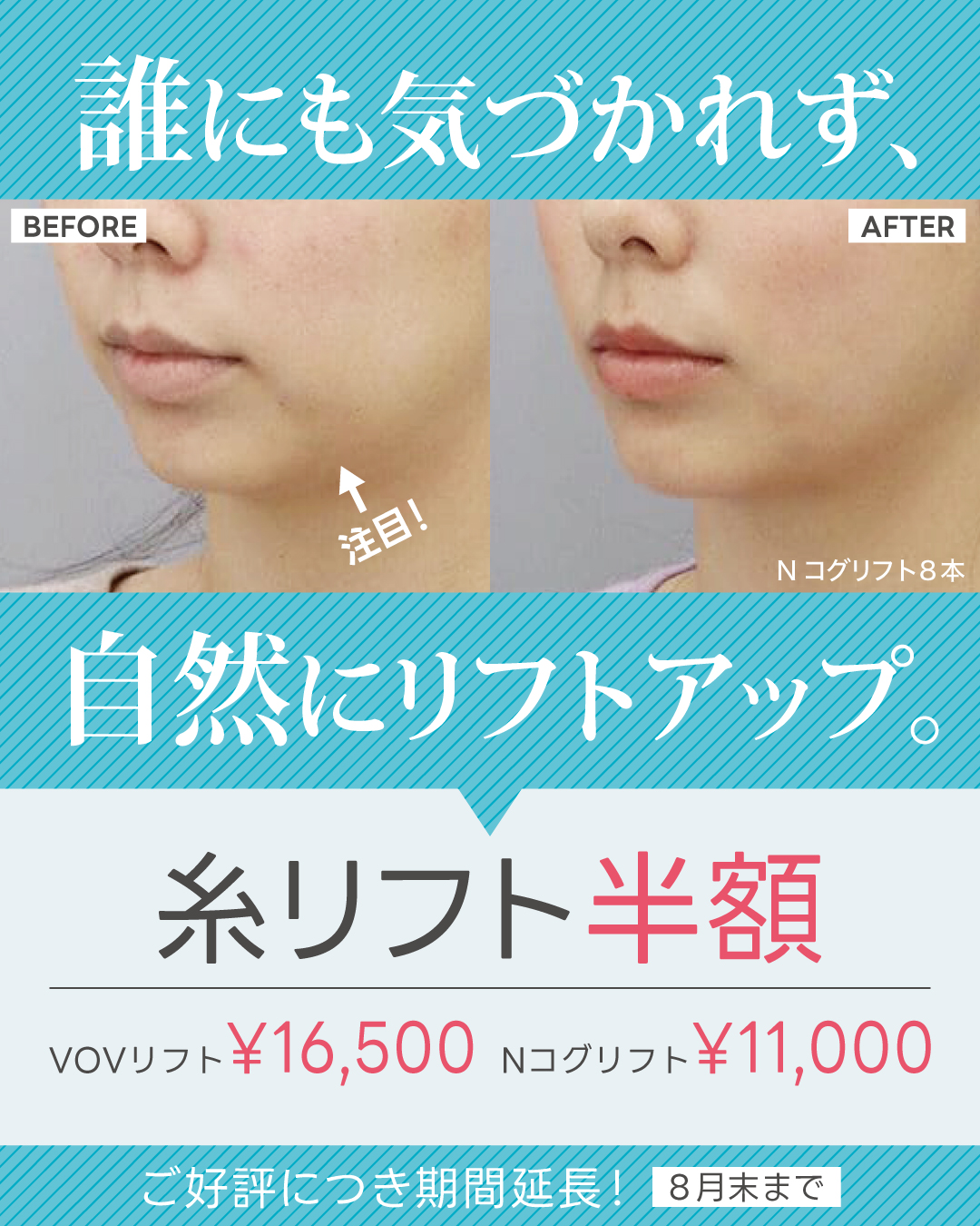 Ncog VOV糸リフト8月末まで