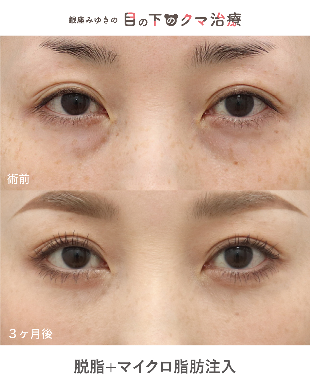 目の下のくま施術症例１