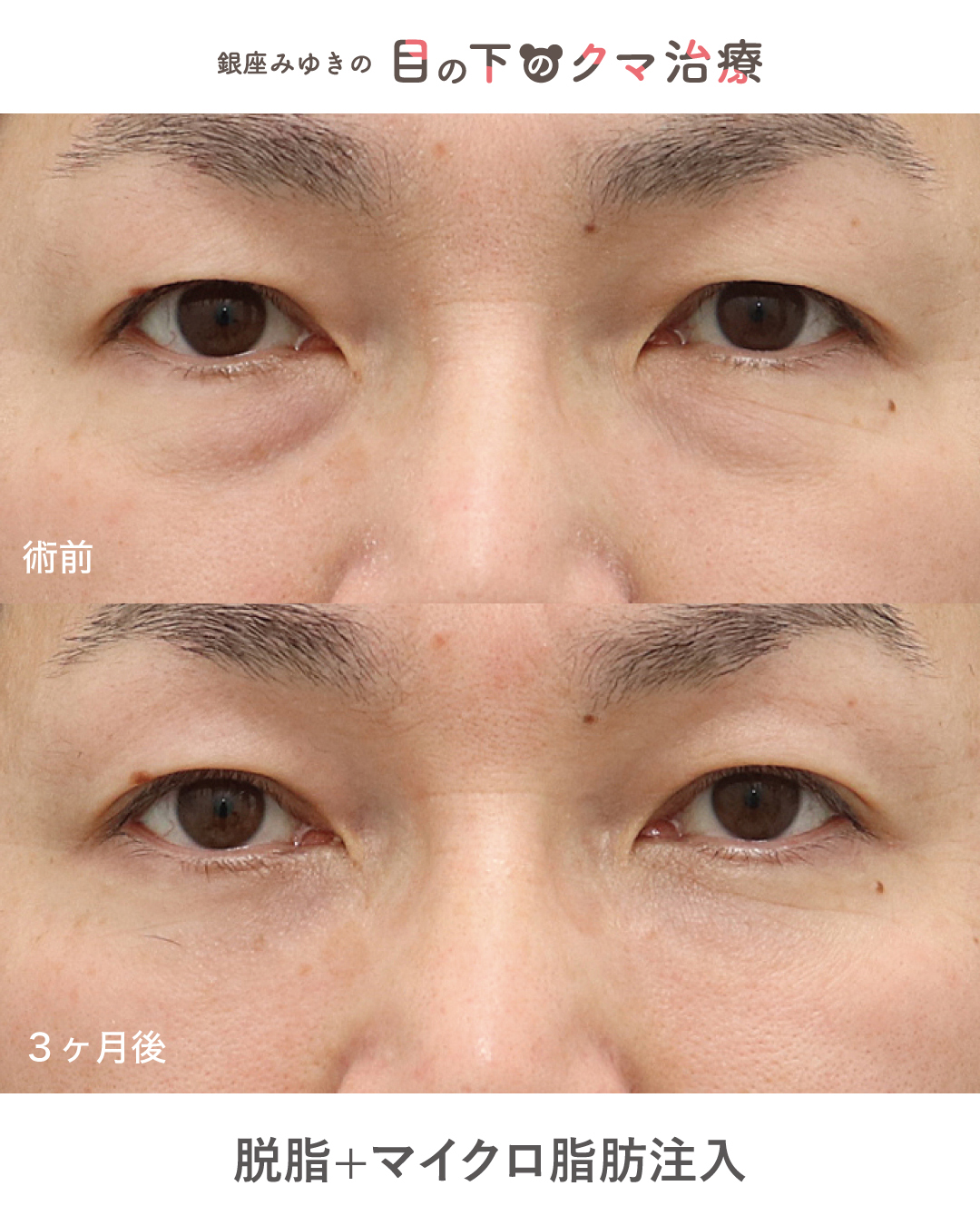 目の下のくま施術症例2