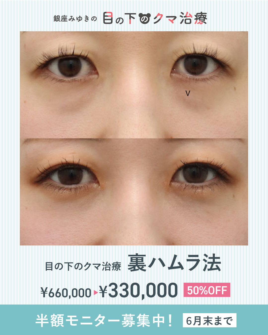 目の下のくま50％OFFキャンペーン！