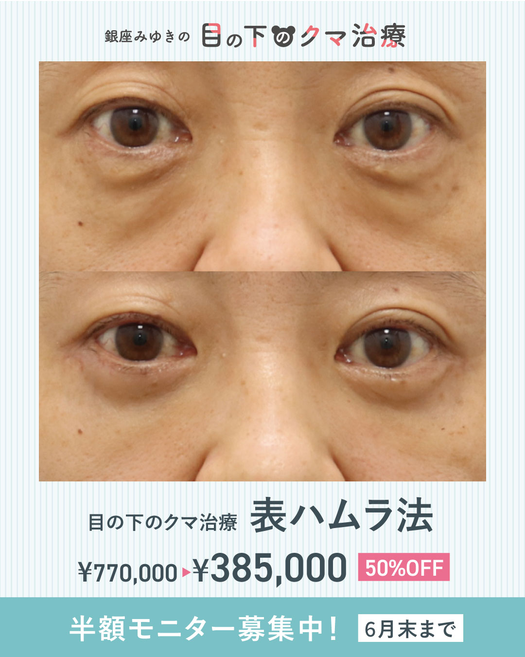 目の下のくま50％OFFキャンペーン詳細！