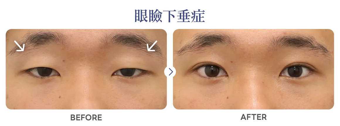 眼瞼下垂の症例