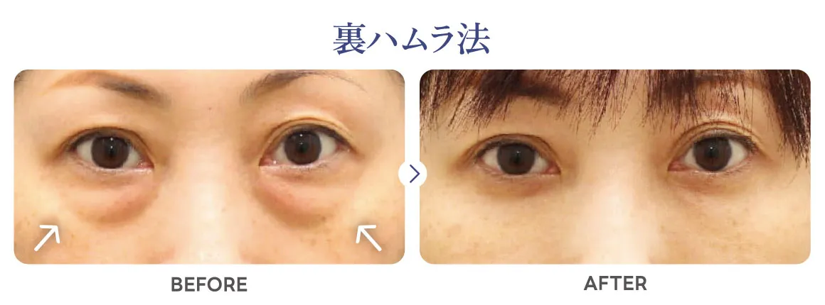 目の下のくま裏ハムラ法の症例