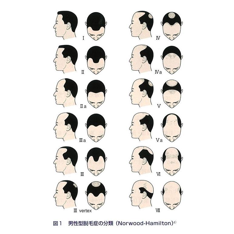 男性型脱毛症の分類 男性型脱毛症の分類