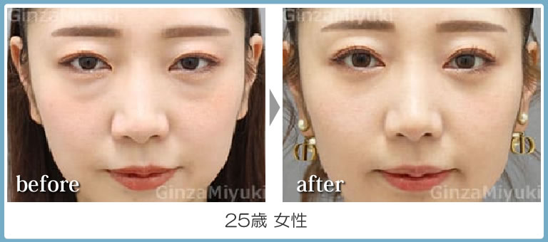 目の下のくま２５歳の症例・軽結膜脱脂法