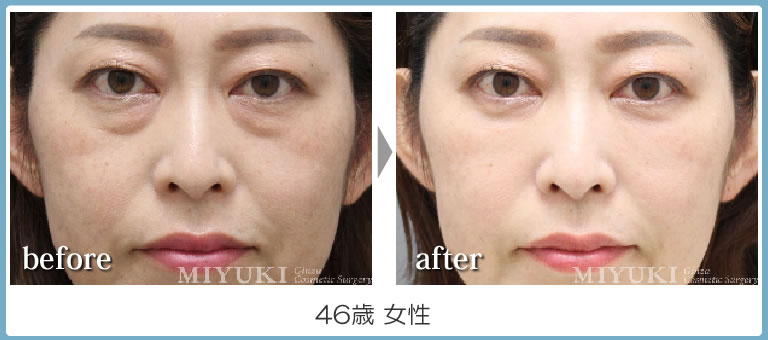 目の下のくま４６歳の症例・軽結膜脱脂法