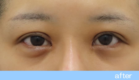 眼瞼下垂の症例10【保険適用】眼瞼挙筋前転法の術後