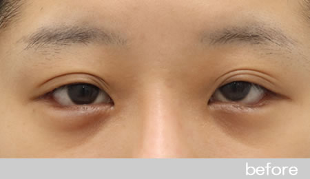 眼瞼下垂の症例10【保険適用】眼瞼挙筋前転法の術前