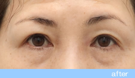 眼瞼下垂の症例12【保険適用】眼瞼挙筋前転法の術後
