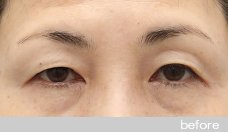 眼瞼下垂の症例12【保険適用】眼瞼挙筋前転法の術前