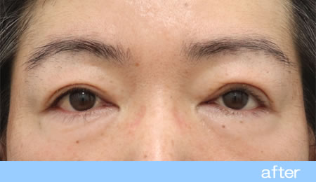 眼瞼下垂の症例13【保険適用】眼瞼挙筋前転法の術後