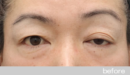 眼瞼下垂の症例13【保険適用】眼瞼挙筋前転法の術前