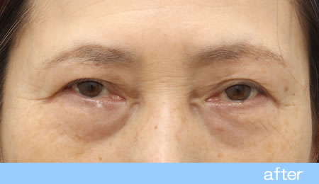 眼瞼下垂の症例14【保険適用】眉毛下皮膚切除法の術後