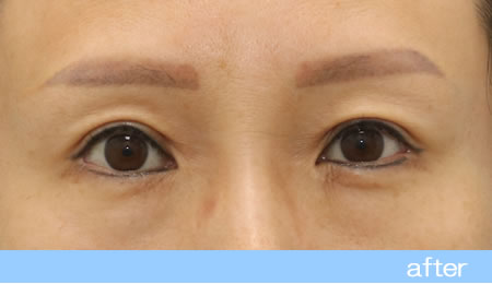 眼瞼下垂の症例16【保険適用】眼瞼挙筋前転法の術後