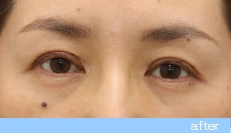 眼瞼下垂の症例18【保険適用】眼瞼挙筋前転法の術後