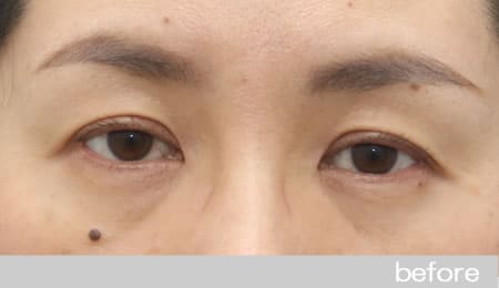 眼瞼下垂の症例18【保険適用】眼瞼挙筋前転法の術前