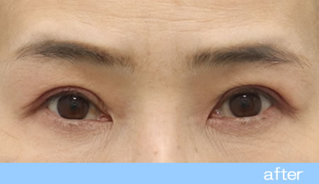眼瞼下垂の症例9【保険適用】眼瞼挙筋前転法の術後