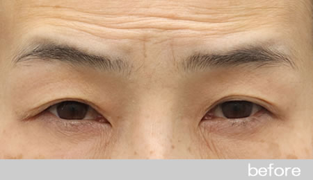 眼瞼下垂の症例9【保険適用】眼瞼挙筋前転法の術前