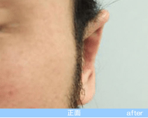 立耳形成の症例の術後（正面）