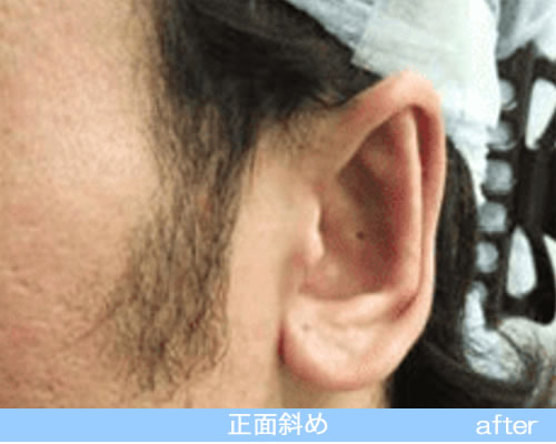 立耳形成の症例の術後（斜め前）