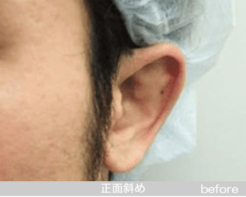 立耳形成の症例の術前（斜め前）