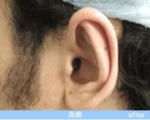 立耳形成の症例の術後（真横）