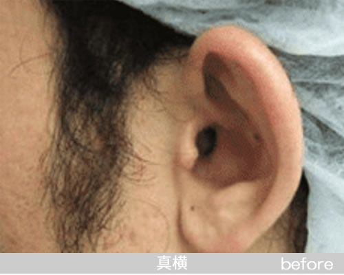 立耳形成の症例の術前（真横）