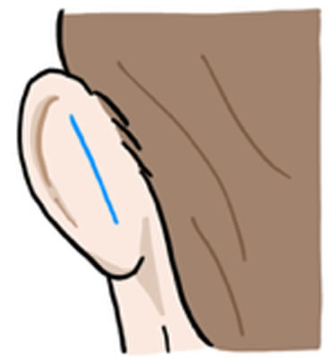 ①耳の裏側を皮膚切開