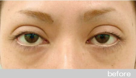 眼瞼下垂の症例1眼瞼挙筋前転法の術前［保険適用］