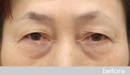 眼瞼下垂の症例5眉毛下皮膚切除法の術前［保険適用］