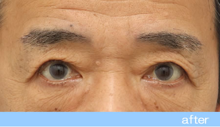 眼瞼下垂の症例15眼瞼挙筋前転法の術後［保険適用］