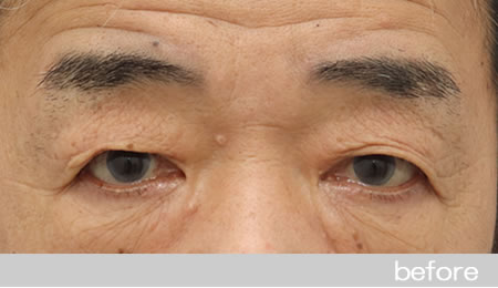 眼瞼下垂の症例15眼瞼挙筋前転法の術前［保険適用］