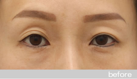 眼瞼下垂の症例16眼瞼挙筋前転法の術前［保険適用］
