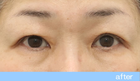 眼瞼下垂の症例17眼瞼挙筋前転法の術後［保険適用］