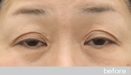 眼瞼下垂の症例17眼瞼挙筋前転法の術前［保険適用］
